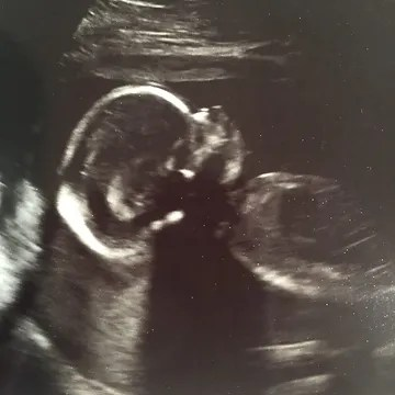ultrasound image of baby